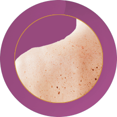 Fab_Website_Services_11.-Mole-Removal