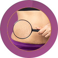 Fab_Website_Services_5. Stretch-Marks-Removal
