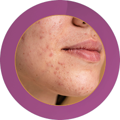 Fab_Meso Facial