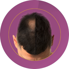 Fab_Website_Services_Hair replacement