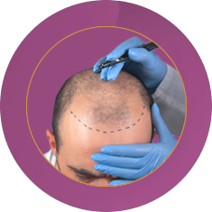 Fab_Website_Services_Hair transplant