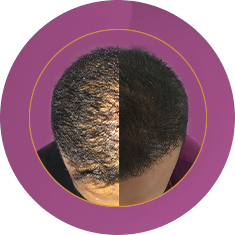 Fab_Website_Services_Scalp Micro Pigmentation