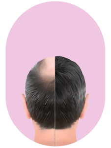 Hair Transplant