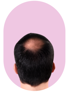 Hair Loss Treatment